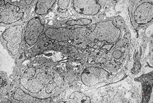 M,3y. | plexus papilloma